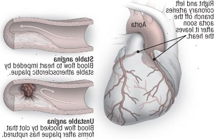 Stabil og ustabil angina