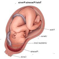 Illustration viser total placenta previa