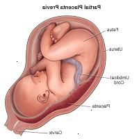 Illustration viser partiel placenta previa