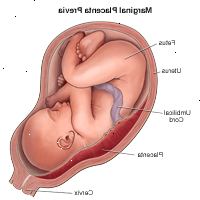 Illustration af marginal placenta previa