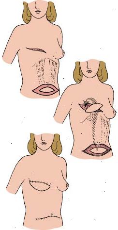 Sporvogn flap procedure viser, hvordan abdominal væv bruges til at rekonstruere den fjernede bryst