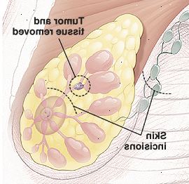 Breast anatomi med cirkel omkring tumor i kanalen viser væv, der skal fjernes. Der er stiplede linjer over brystvorten og i armhule at vise små buede indsnit sites.