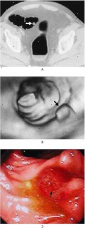 Colorectal polyp i colon sigmoideum ses af CT-scanning (A), virtuel koloskopi (B), og konventionelle koloskopi (C).